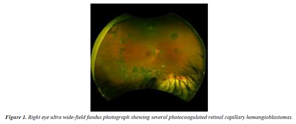 ophthalmic-and-eye-research-photocoagulated