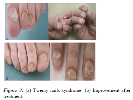 Trachyonychia - Altmeyers Encyclopedia - Department Dermatology
