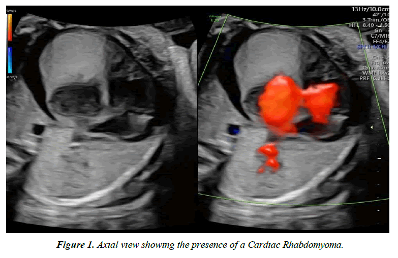 pregnancy-and-neonatal-medicine-cardiac-rhabdomyoma