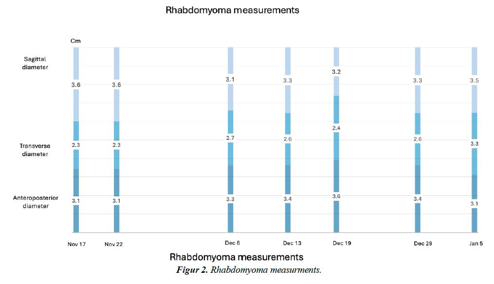 pregnancy-and-neonatal-medicine-cardiac-rhabdomyoma