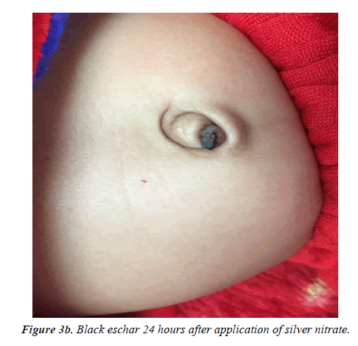 Pre-activated silver nitrate for umbilical granuloma
